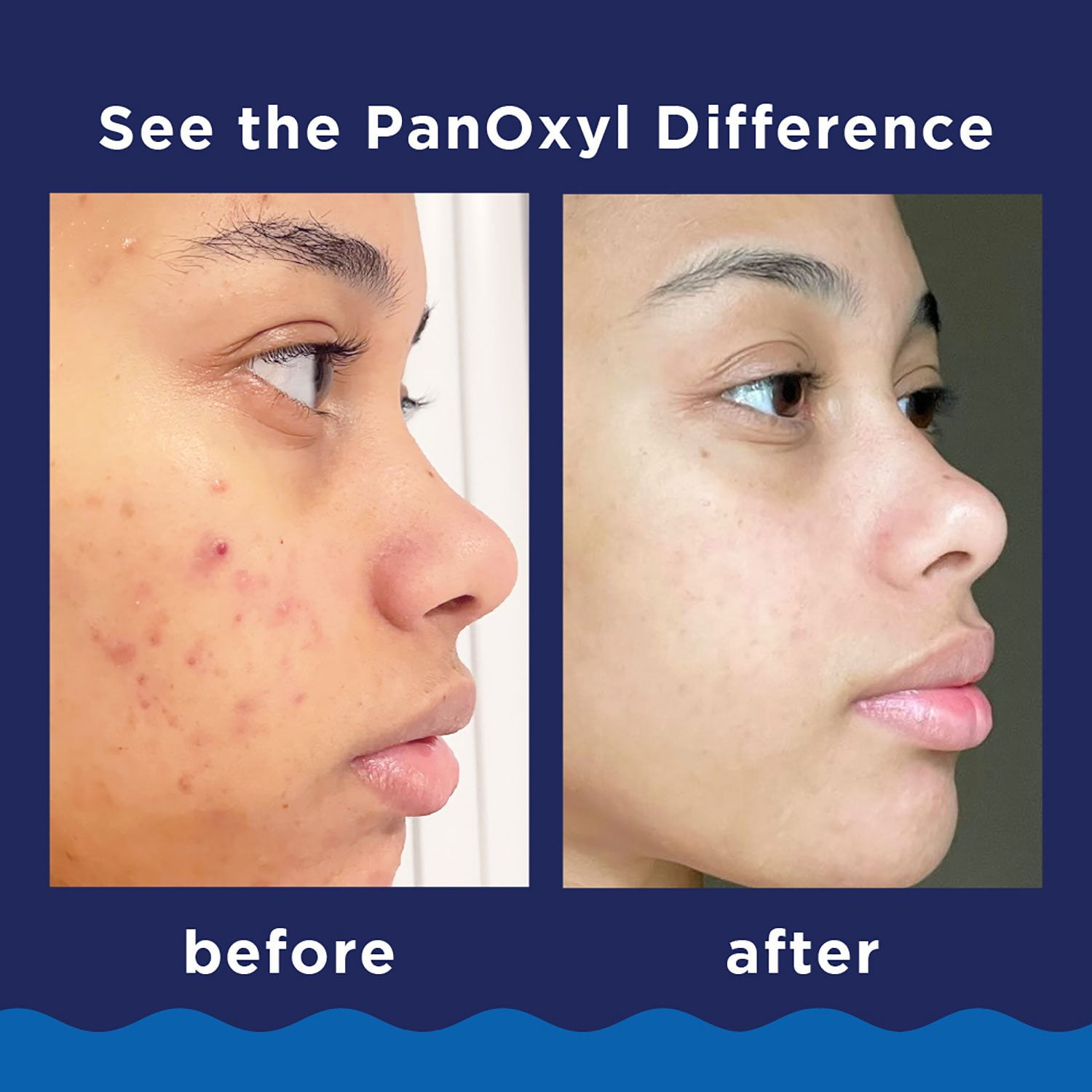 PanOxyl Acne Foaming Wash, 10% Benzoyl Peroxide, 5.5 oz., 2 pk. - Image 5